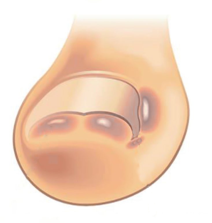 toenail painful